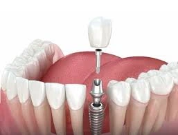 Dental Implant and Hollywood Smile Packages in Turkey
