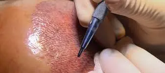 Sapphire FUE hair transplant procedure