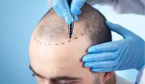 Sapphire FUE hair transplant cost