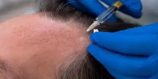 Benefits & Risks of Sapphire FUE Hair Transplant