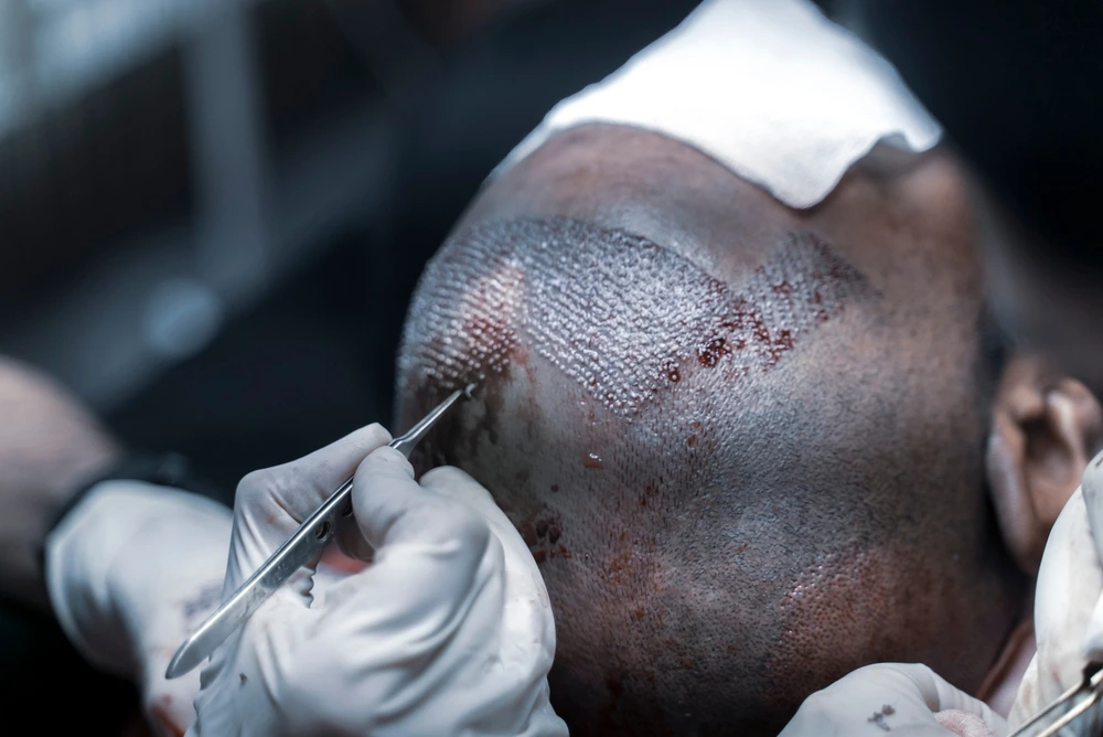 أفضل 10 أسباب لإجراء زراعة الشعر للرجال