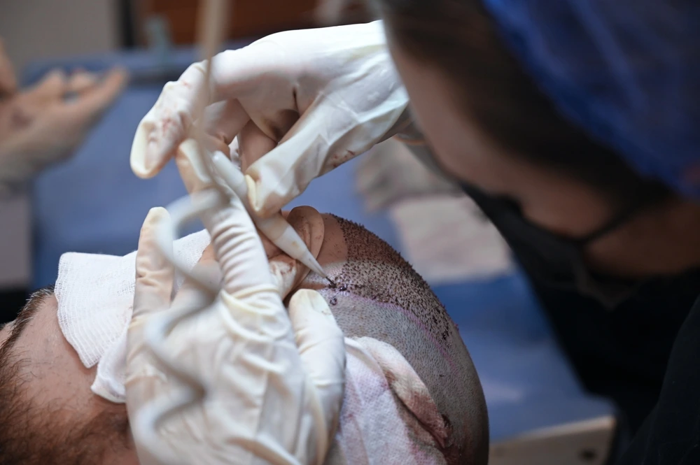 أفضل تقنيات زراعة الشعر للرجال