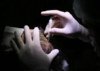 أفضل زراعة شعر بتقنية DHI في تركيا: كل ما تحتاج معرفته