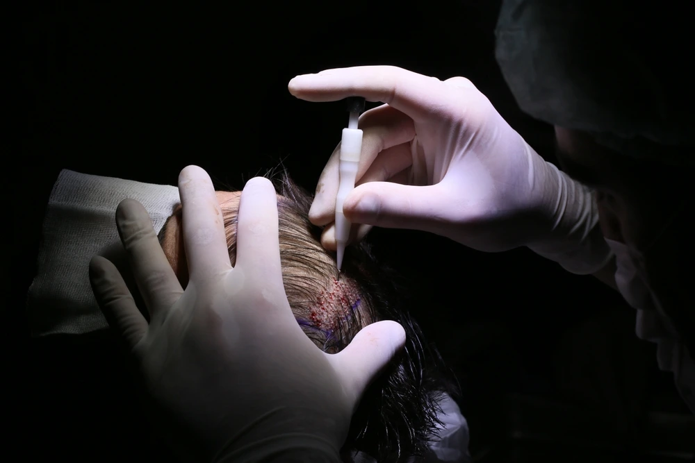 أفضل زراعة شعر بتقنية DHI في تركيا: كل ما تحتاج معرفته