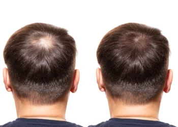 الفرق بين زراعة الشعر الطبيعي والصناعي