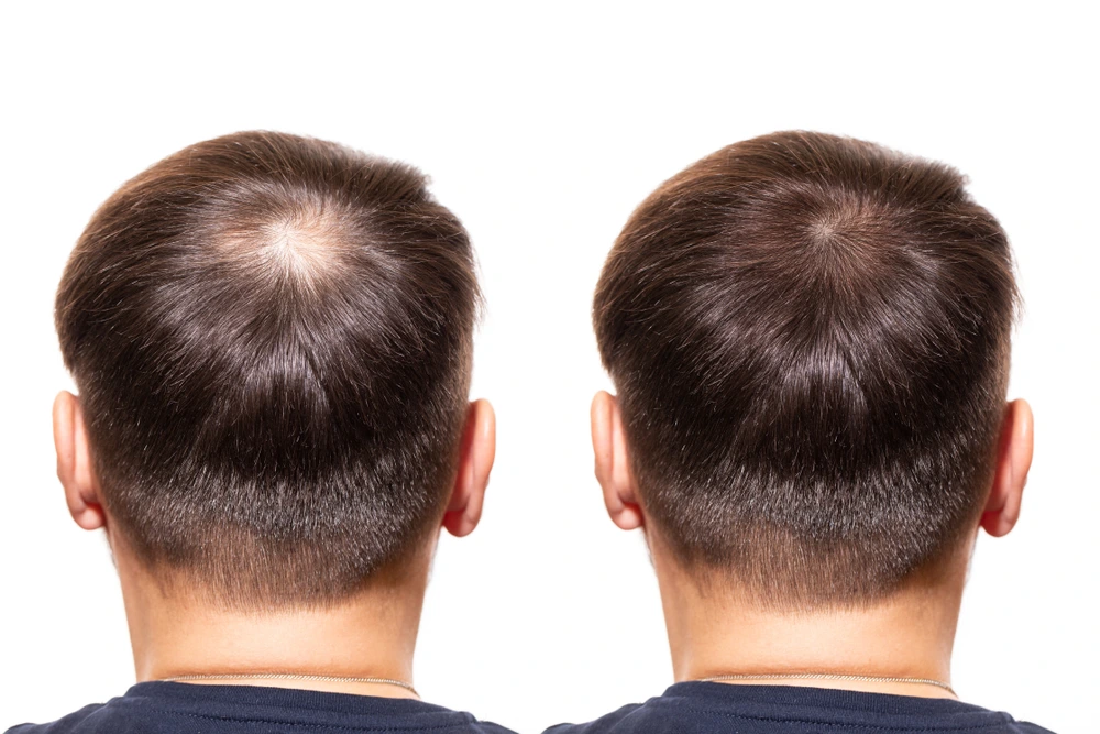 الفرق بين زراعة الشعر الطبيعي والصناعي
