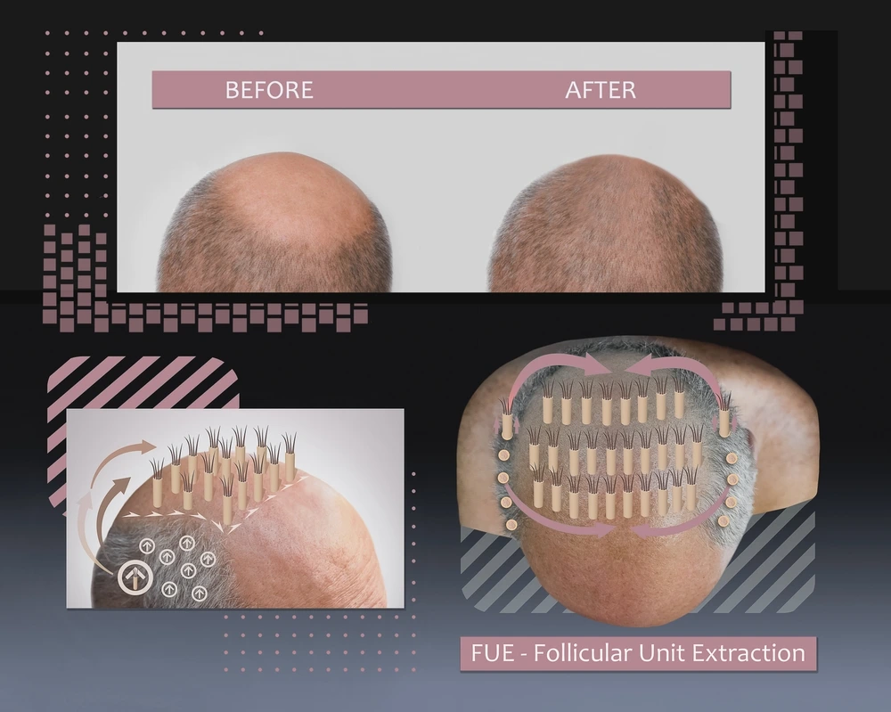 خطوات إجراء زراعة الشعر بتقنية FUT