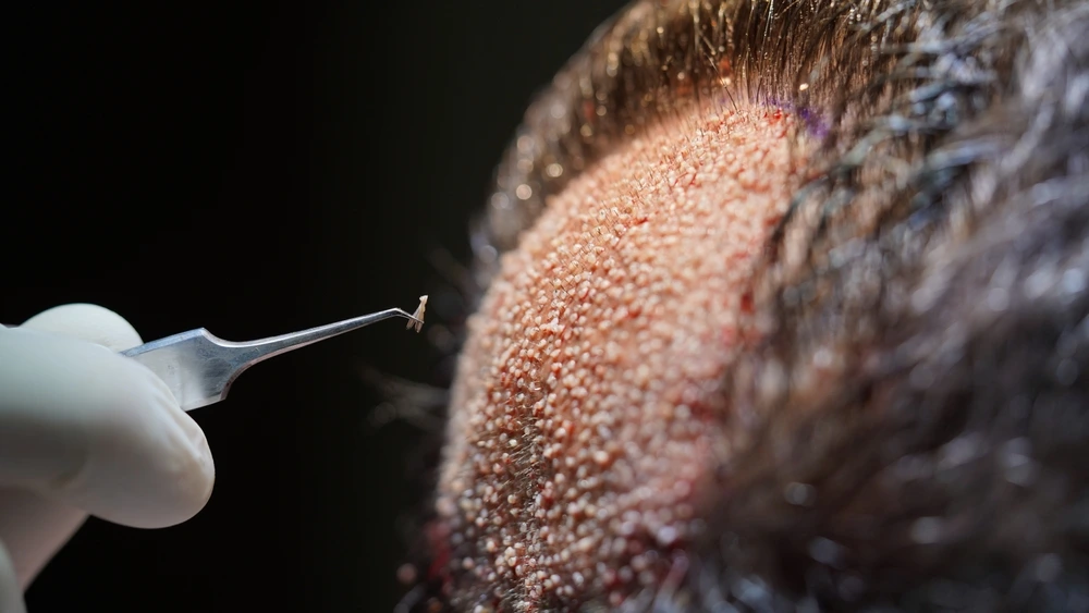 خطوات زراعة الشعر للرجال