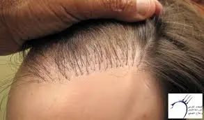 Hair Implants