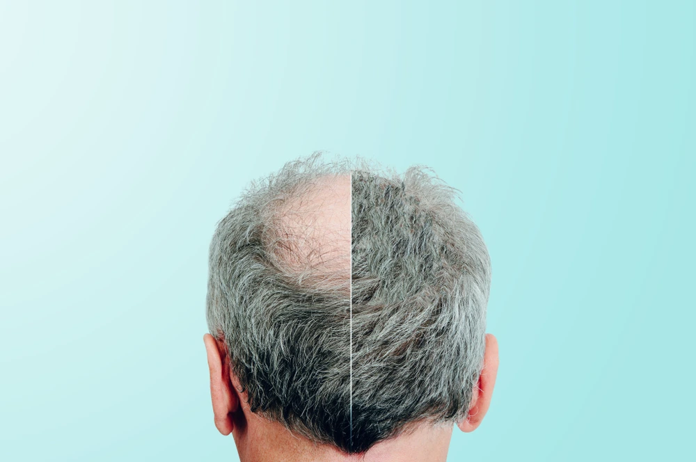 زراعة الشعر الصناعي مقابل زراعة الشعر الطبيعي
