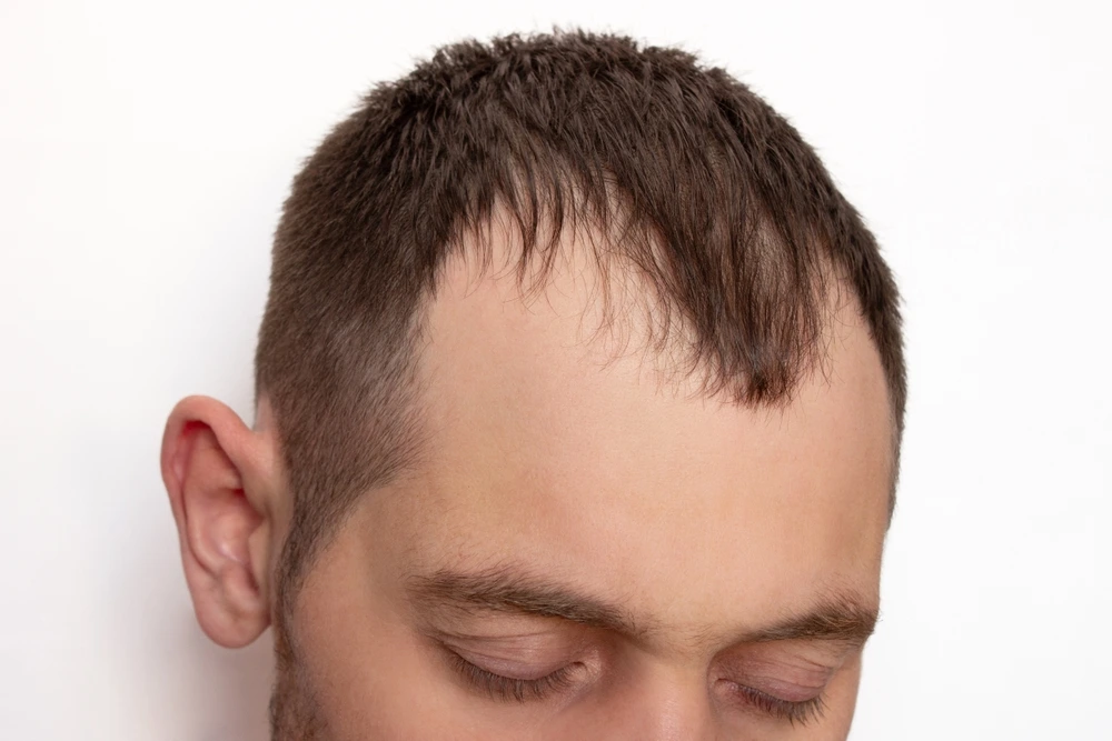 زراعة الشعر الصناعي