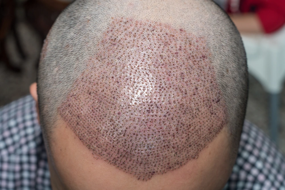 زراعة الشعر الطبيعي