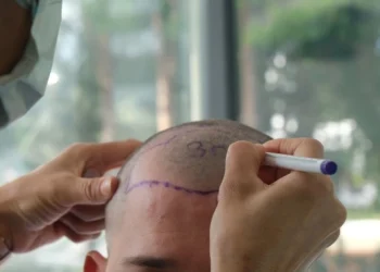 زراعة الشعر: المميزات والعيوب والتكاليف وكل ما تود معرفته