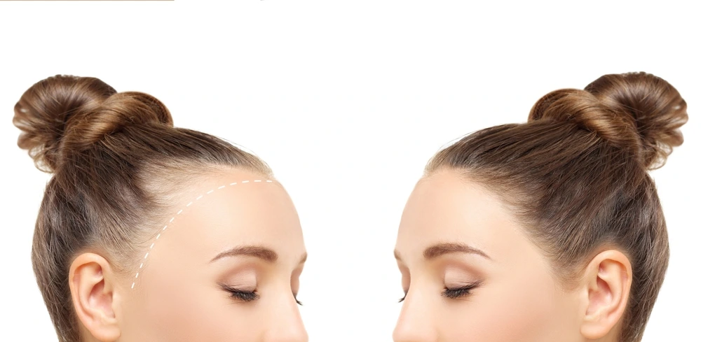 زراعة الشعر للنساء: الأسباب والحلول والتكلفة في تركيا