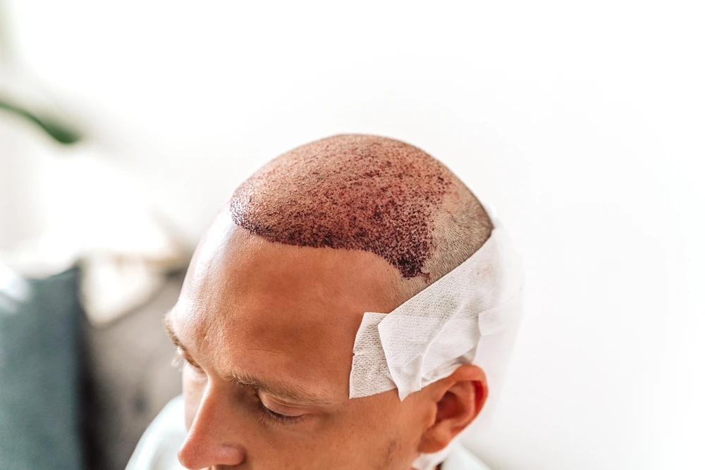 فوائد وعيوب زراعة الشعر بتقنية FUT