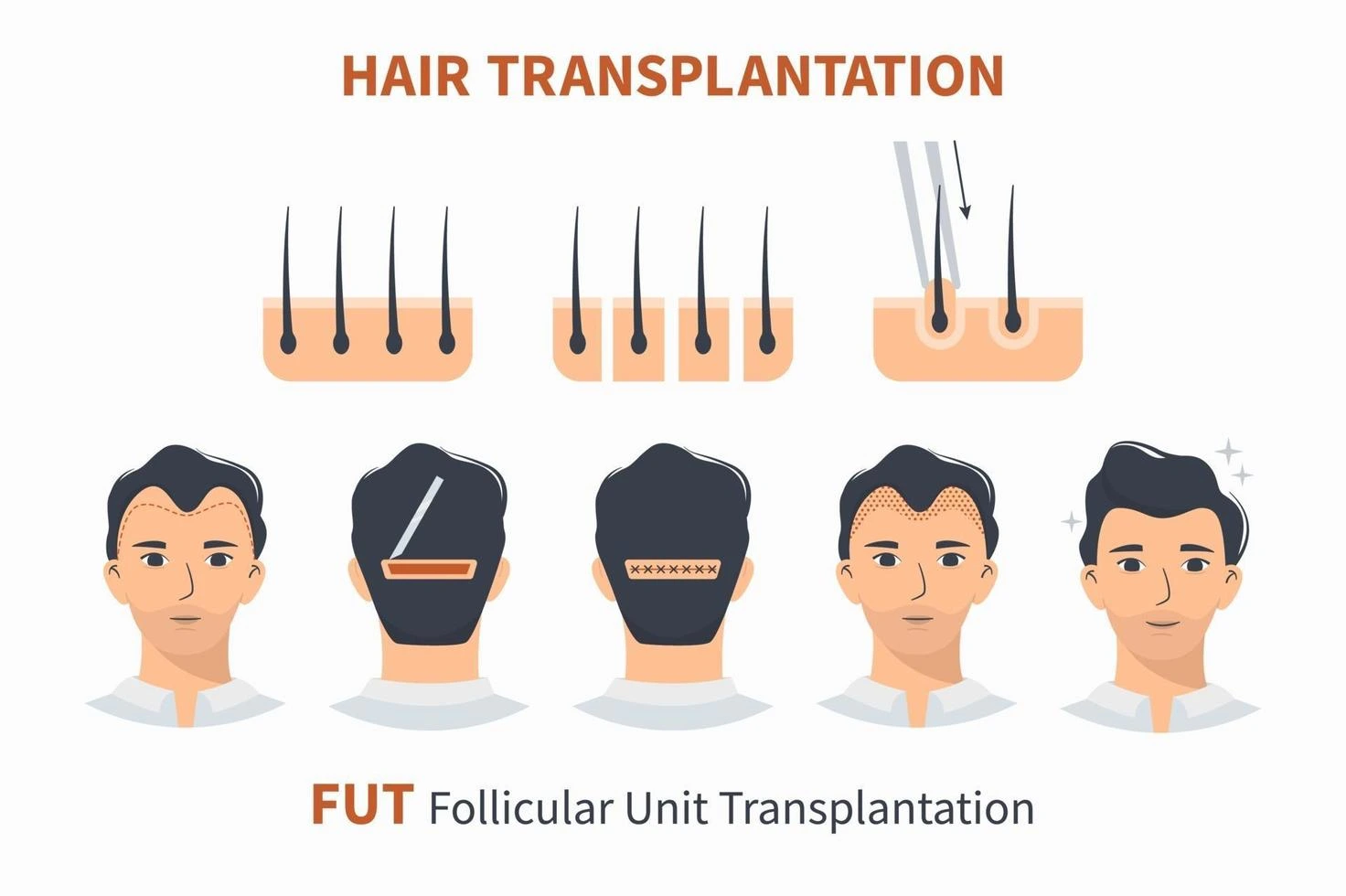 كل ما تود معرفته عن زراعة الشعر بتقنية FUT