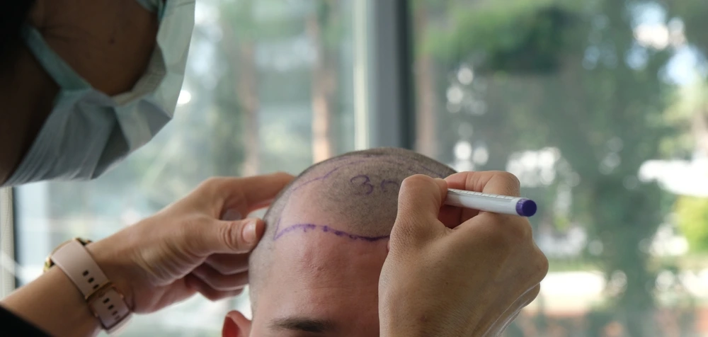 ما هي زراعة الشعر؟