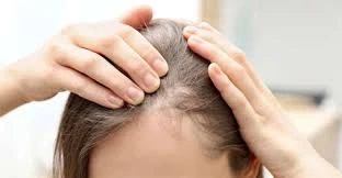 تكلفة زراعة الشعر في تركيا: كل ما تحتاج معرفته حول التقنيات والأسعار