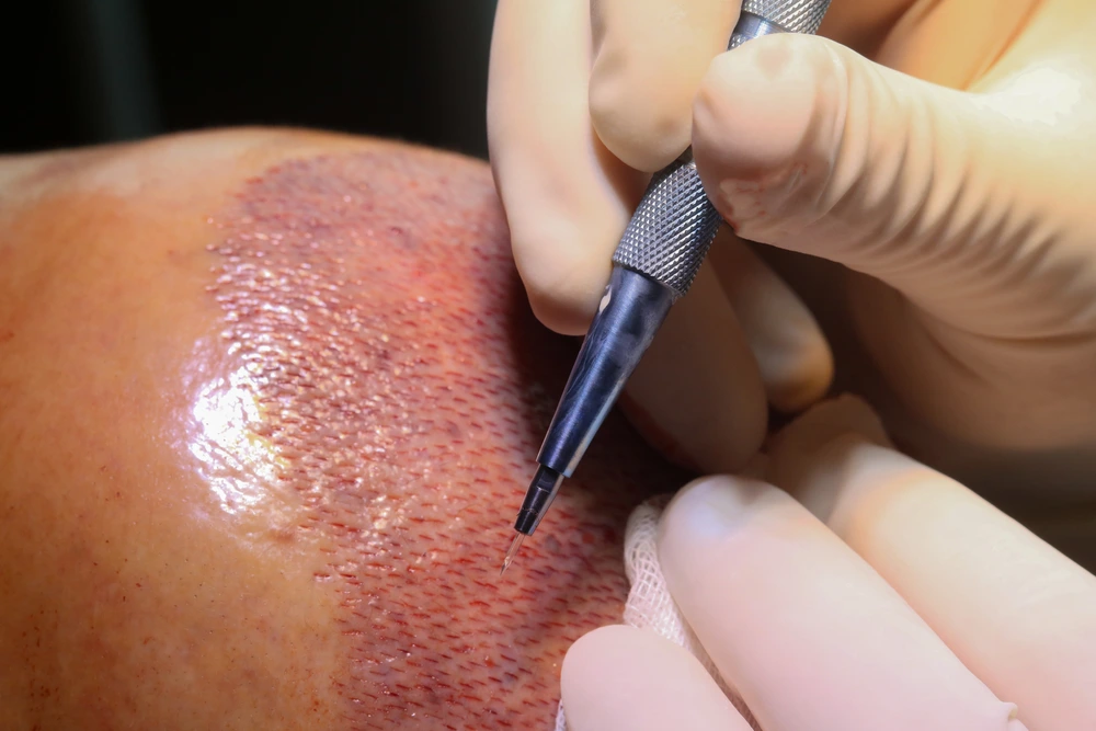 تكلفة زراعة الشعر بتقنية السفير FUE