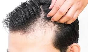 Factors Affecting the Cost of Hair Transplant in Turkey