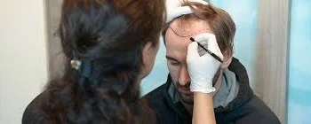 Turkey Hair Transplant Cost in 2025: What You Need to Know