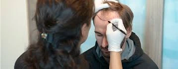 أسعار زراعة الشعر في تركيا