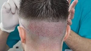 تكلفة زراعة خط الشعر مقارنة بزراعة الشعر الكامل في تركيا