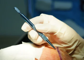 زراعة الشعر بتقنية السفير FUE: كل ما تود معرفته
