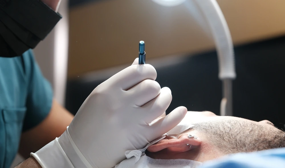 فوائد ومخاطر زراعة الشعر بتقنية السفير FUE