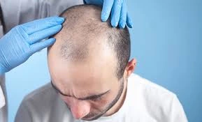 لماذا يُنصح باختيار تركيا لزراعة الشعر؟