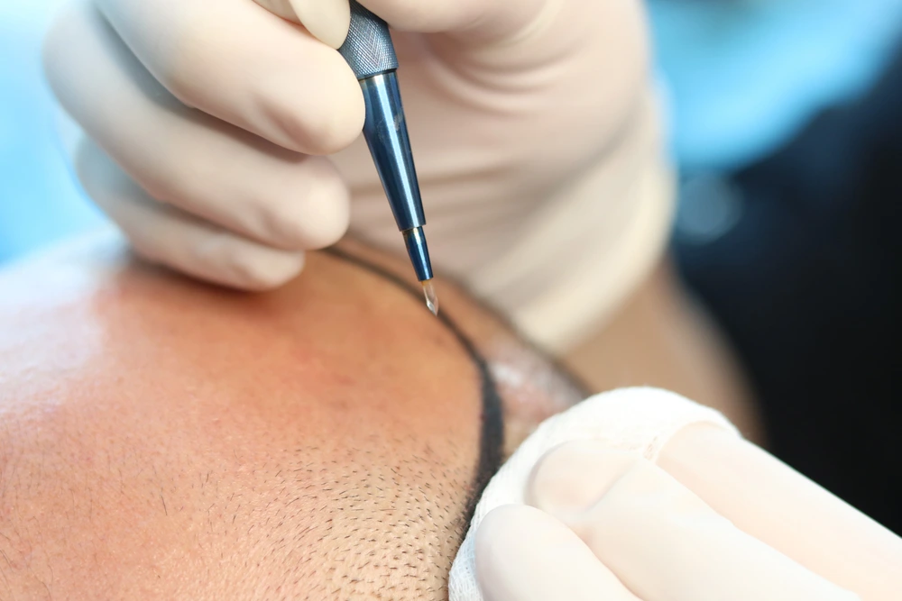 ما هي زراعة الشعر بتقنية السفير FUE؟