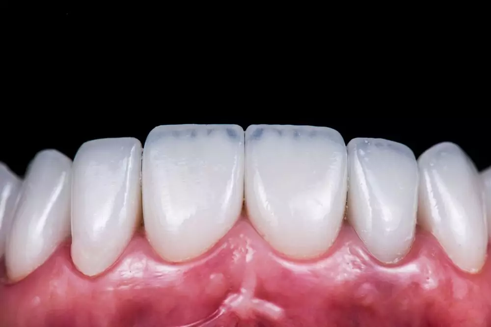 Why Get Veneers in Turkey?