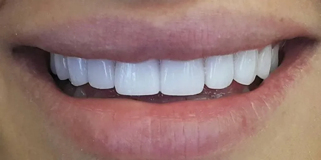 What Are Emax Crowns?