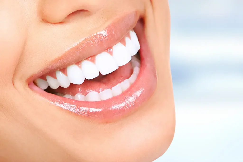 What is a Hollywood smile?