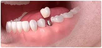 What are dental implants?