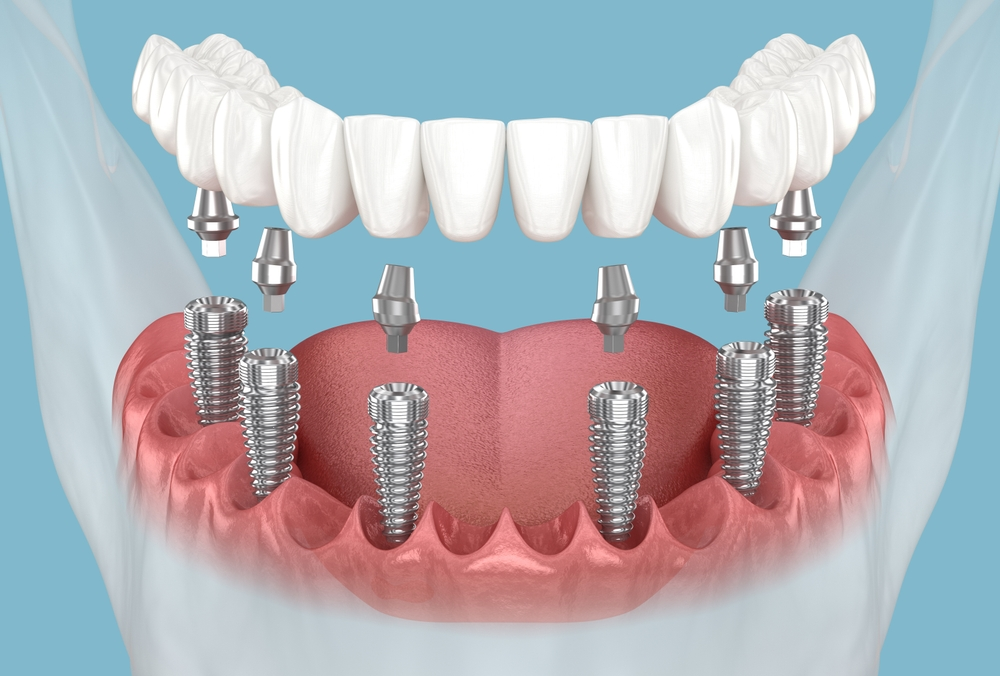 What Are All on 6 Dental Implants?