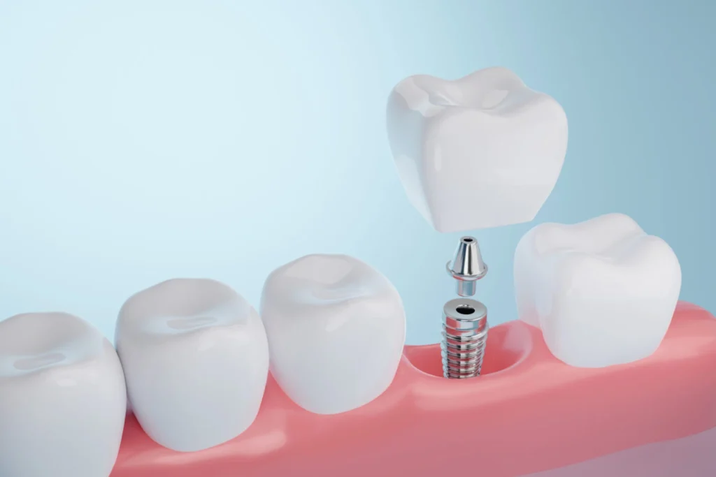 What are Titanium Dental Implants?