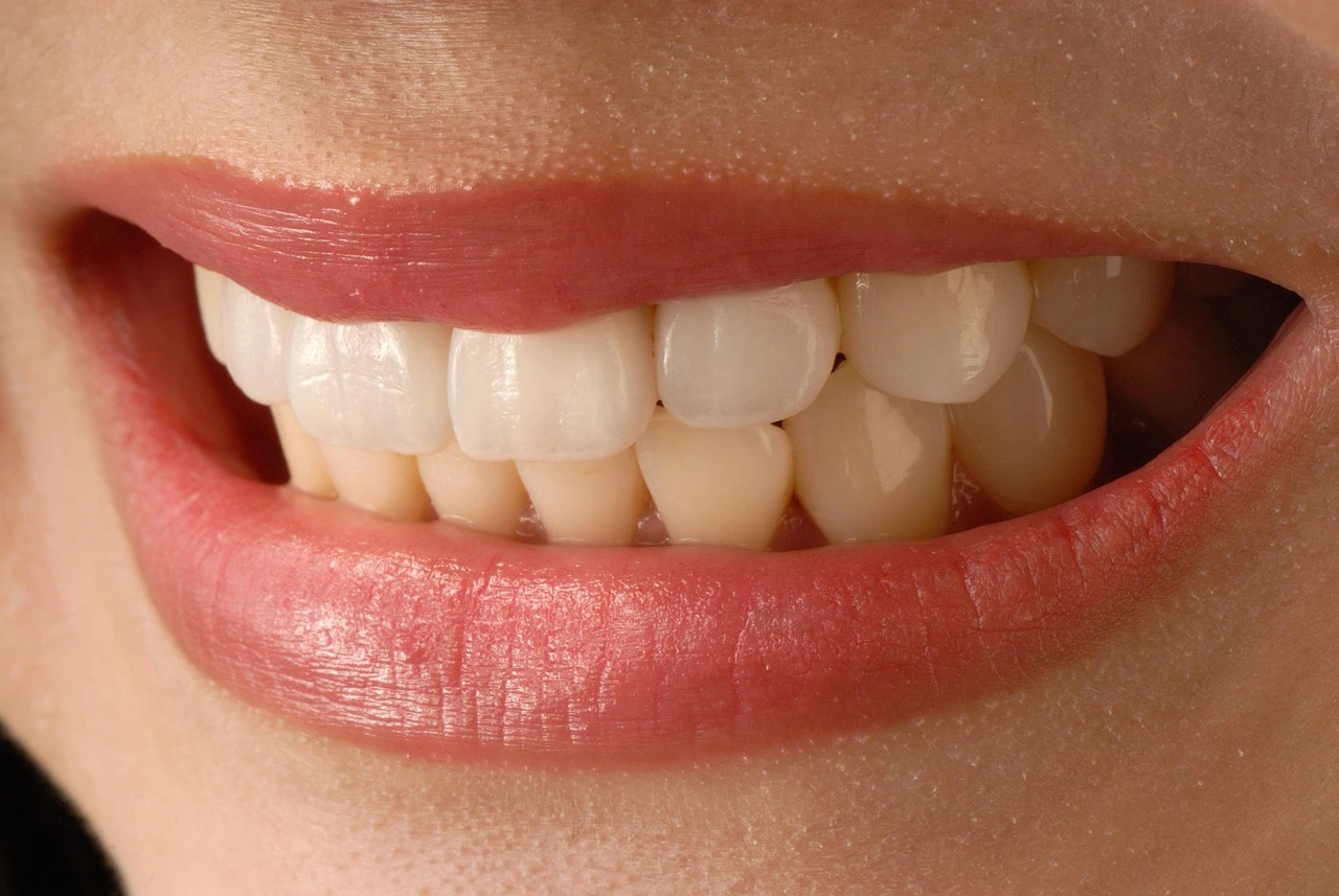 Porcelain Veneers: The Ultimate Guide to a Perfect Smile