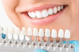  What Are Porcelain Veneers?