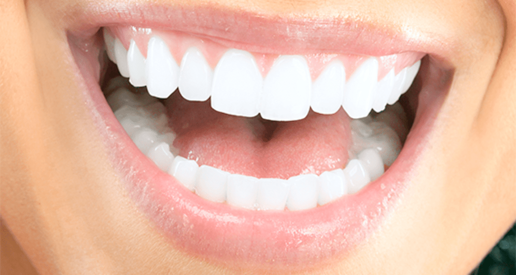 What Are Lumineers? Features, Drawbacks, & Prices