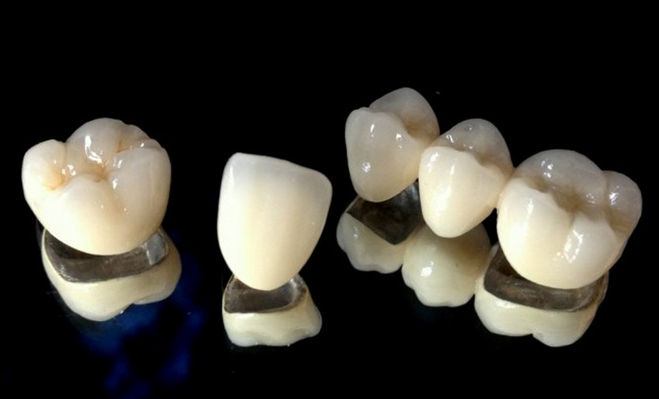 Types of Emax Dental Crowns