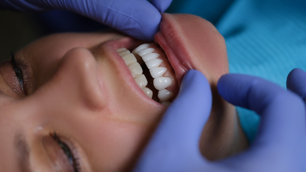 Signs That Your Veneers Need Replacement