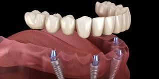 Why Choose Turkey for Dental Implants?