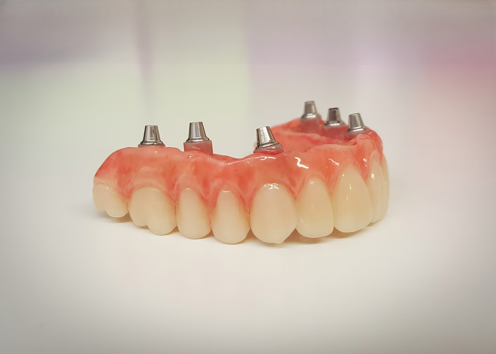 All on 6 Dental Implants Procedure Step-by-Step
