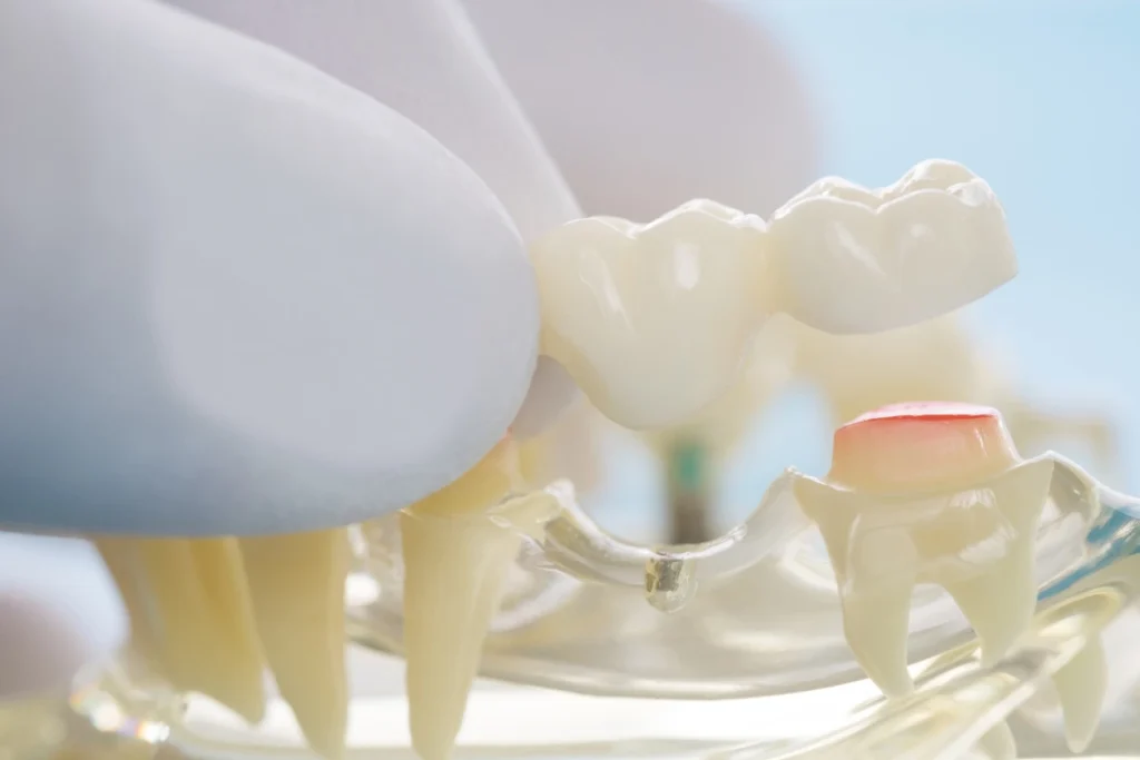 Titanium Dental Implants Vs. Ceramic Dental Implants