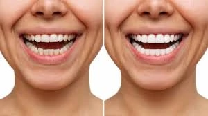 Porcelain vs. Composite Veneers