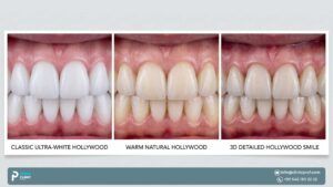 3 Types of Hollywood Smile in Istanbul