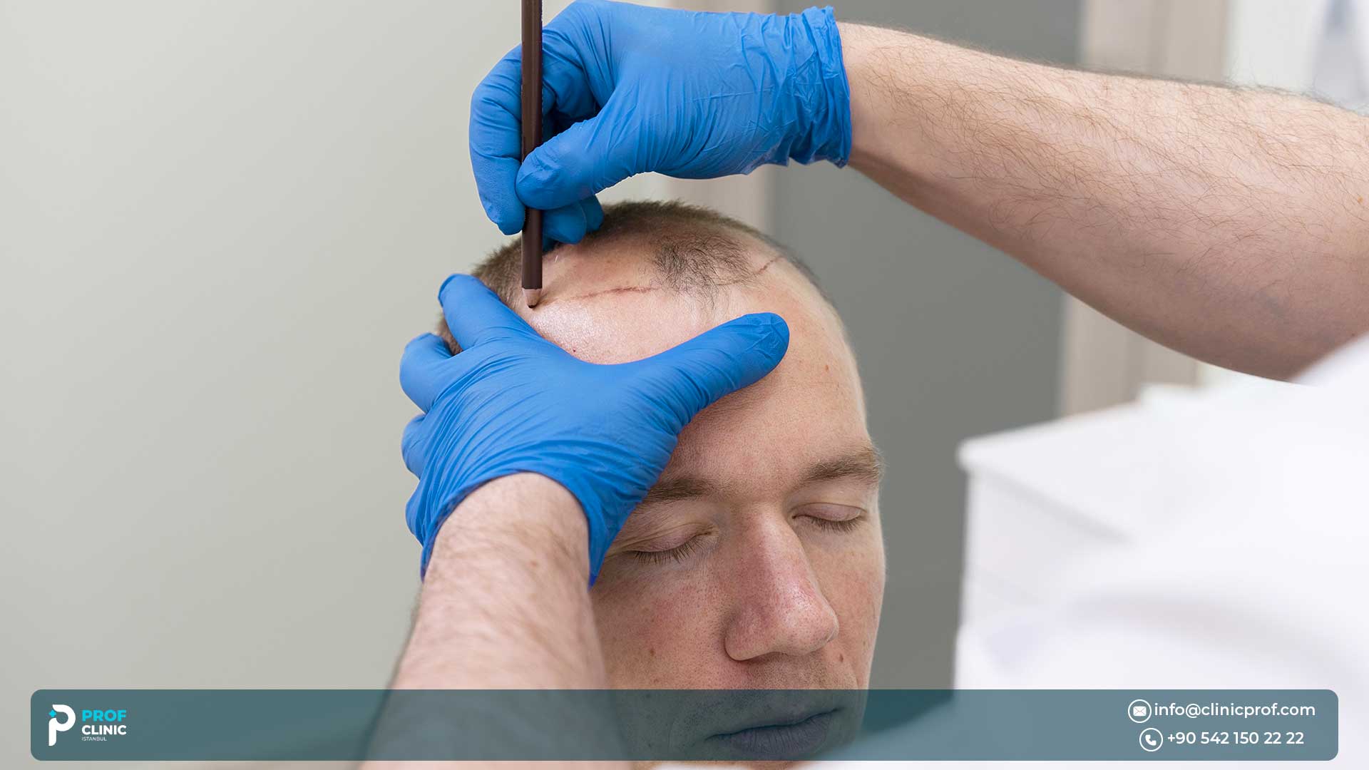 Pros and Cons of hair transplantation
