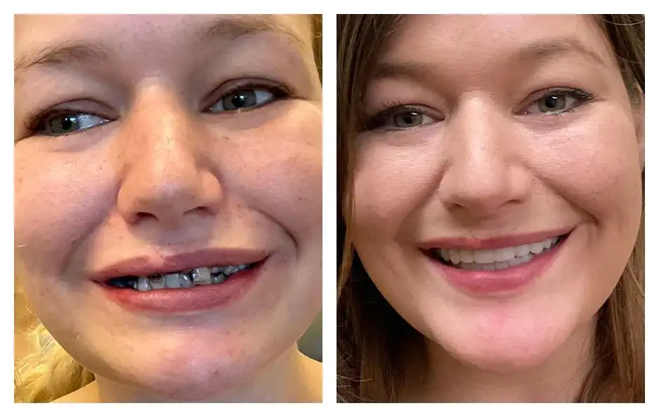 All on 6 before and after