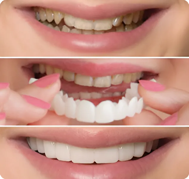 What Are Removable Dental Veneers?